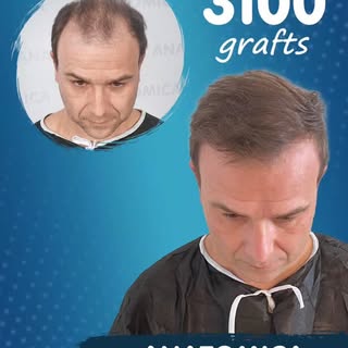 📍 3100 Follicular Units – Anatomica Clinic

✨ Achieve denser, stronger, and natural-looking hair wi