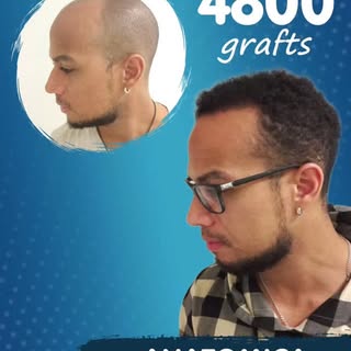 4,800 grafts. A powerful transformation in a single session. #hairtransplant #anatomicaclinic