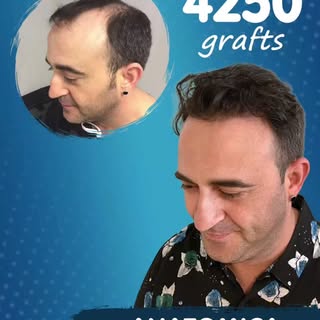 📍 4250 Follicular Units – Anatomica Clinic
✨ Fuller, stronger and natural-looking hair with 4250 gr