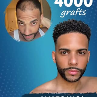4000 Grafts Procedure ✨

Our patient shared his journey with us. Seeing the transformation and the n