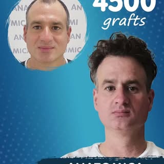 🔥 4500 Graft Hair Transplant Result 🔥

A natural hairline, increased density, and results that spe