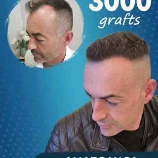 ✨ Ergebnis einer Haartransplantation mit 3000 Grafts
Ein natürlicher Look, mehr Haardichte und neues