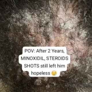 If Minoxidil, steroid shots, and “everything else”

 worked the way people expect… this client

 wou