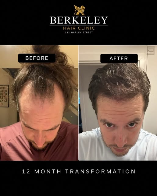 2800 graft hyper-natural hairline reconstruction ⭐️