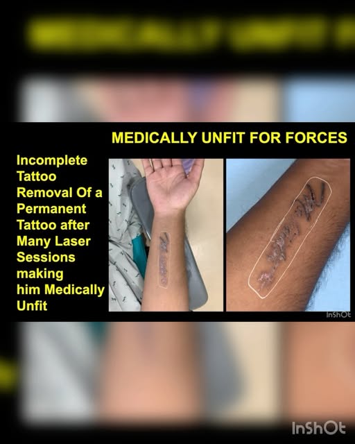 TATTOO REMOVAL One Method of Tattoo Removal is Explained By Dr. Harish Ghildiyal Which Makes you Eli
