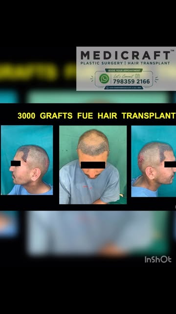 An FUE (Follicular Unit Extraction) hair transplant is a surgical procedure that removes individual 