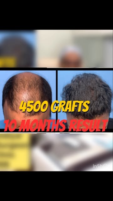 Grade 6 baldness FUE hair transplant treating severe hair loss—where the front hairline and crown (b