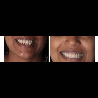 Tiny gaps? Broken edges? Uneven teeth?
We fix it all — pain-free & crown-free 🤍
Semi-direct smile d