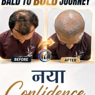 Bald to Bold 🔥 | Confidence Starts Here

From a receding hairline to a confident new look—this tran