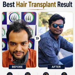 Life-Changing Hair Transplant ✨ | One Decision. New Confidence.

One decision can change the way you