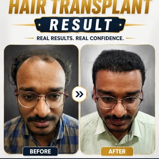 Natural Hair Transplant Result | Real Transformation ✨

Dreaming of a natural-looking hairline? Here