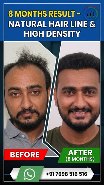 Are you struggling with hair loss, a receding hairline, or baldness? It's time to regain your confid