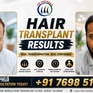 Best Hair Transplant Result Story ✨ | #BaldToBold #HairClinic #HairGoals 

He didn't want to hide un