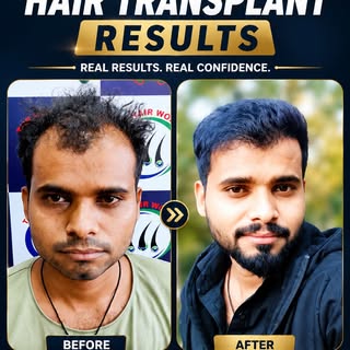 🔥 Superb Hair Transplant Result | Real Patient Transformation | The Hair World, Surat
🔥 Superb Hai