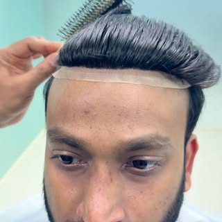 Most Narural looking Hairline patch. Best Hair fixing in Bangalore 🔥🔥 call 9110221804 / 9742549827