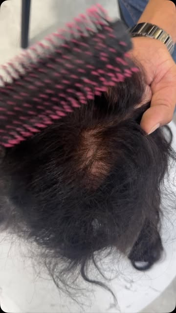 ✨ Ultra Low Density Hair Patch – Natural Look, Maximum Confidence! ✨

Looking for a hair patch that 