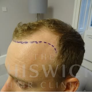 A great example of how a crown and front third FUE of 2120 grafts looks like.

#fue #consultation 
#