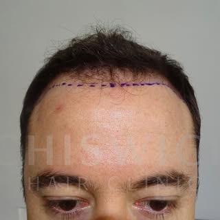 A very natural result with 1890 grafts. They definitely made a difference to the hairline, front thi