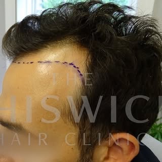 FUE to hairline and temples. 1800 grafts carefully extracted and implanted by Dr Eibi Iniekio.

#fue