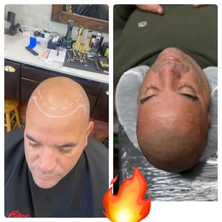 scalpmicropigmentation #smp #hairloss #hairtattoo #scalptattoo #hairlosstreatment #hairlosssolution 