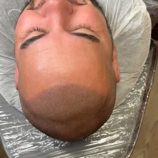 scalpmicropigmentation #smp #hairloss #hairtattoo #scalptattoo #hairlosstreatment #hairlosssolution 