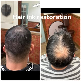 #scalpmicropigmentation #smp #hairloss #hairtattoo #scalptattoo #hairlosstreatment #hairlosssolution