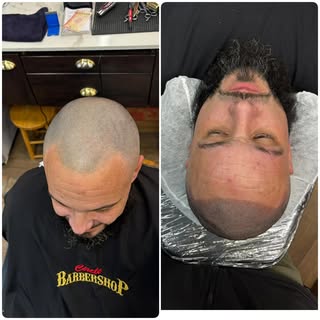 #scalpmicropigmentation #smp #hairloss #hairtattoo #scalptattoo #hairlosstreatment #hairlosssolution