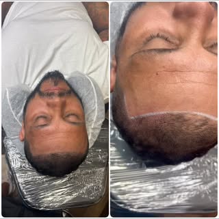 scalpmicropigmentation #smp #hairloss #hairtattoo #scalptattoo #hairlosstreatment #hairlosssolution 