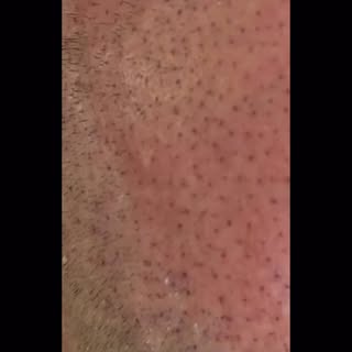 SMP 1st session close up!  @folicule @bishopsmp #scalpmicropigmentation #smp #1stsession #northhaven