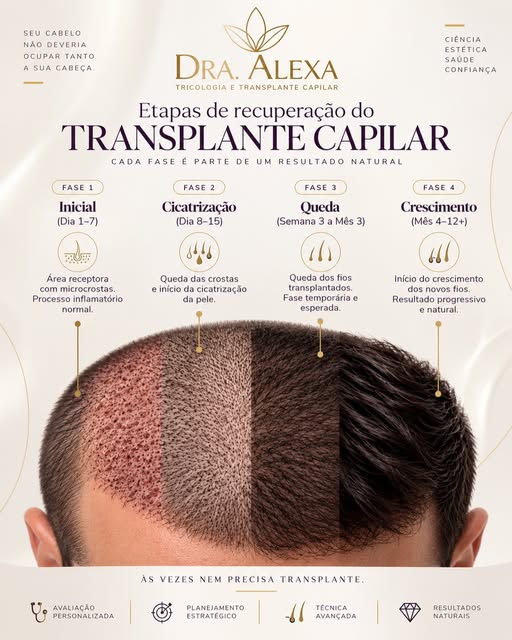 Sabía q essas etapas sempre acontecem em qualquer transplante ! A mais asustadora é a fase do shock 