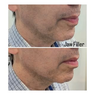 Strong profile. Natural definition. 

A great before & after of male jawline filler, designed to enh
