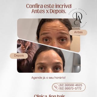 ✨ Resultado que fala por si!

Suavização das linhas da testa com um resultado natural, preservando a
