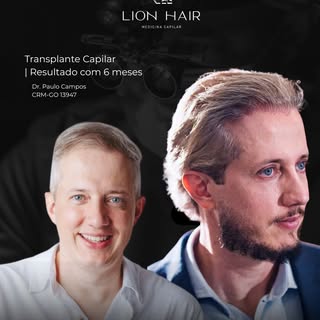 Quando técnica e planejamento encontram naturalidade, o resultado fala por si. 

Cada transplante ca