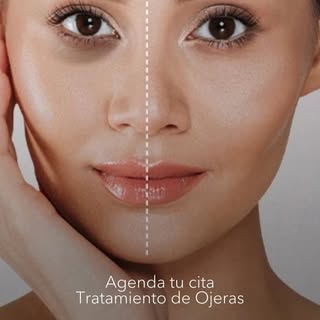 ❤️ El tratamiento de ojeras con ácido hialurónico es una solución rápida y eficaz para reducir la ap