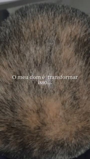Meu dom é ajudar a devolver cabelos, autoestima e saúde!
Com diagnóstico, estratégia e um tratamento