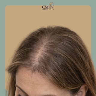 Avant / Après — Trichopigmentation capillaire chez une patiente.

La trichopigmentation est une tech