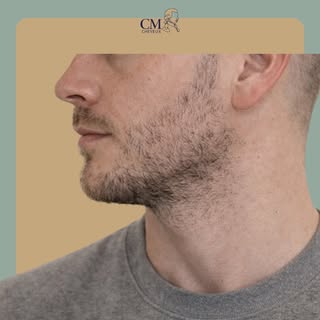 Avant / Après — Greffe de barbe FUE.

La greffe de barbe par technique FUE permet de densifier une b
