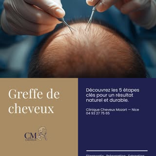 Déroulement d'une greffe de cheveux : 5 étapes clés pour un résultat naturel

Vous envisagez une gre