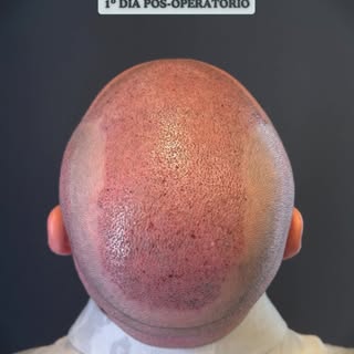 ✨5.700 enxertos. Mais de 12.000 fios.

🚨Agora repare com atenção:

▪️Essa imagem foi registrada no 