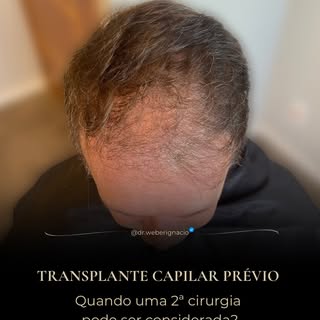 Uma segunda cirurgia de transplante capilar pode ter suas limitações.

Antes de considerar um novo p