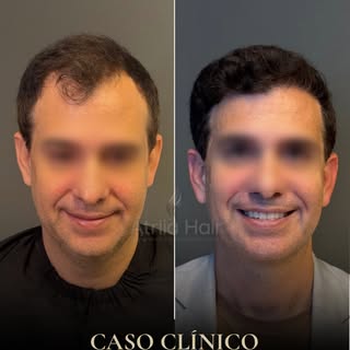 📓REGISTRO CLÍNICO

▪️Diagnóstico: Alopecia androgenética masculina (Norwood V).

▪️Indicação: Recon