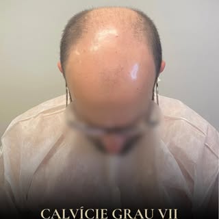 ▪️Evolução clínica de um caso de alopecia androgenética avançada, conduzido em duas etapas cirúrgica