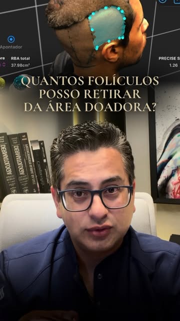 Não existe um número único de folículos que possa ser aplicado a todos os pacientes.

O planejamento