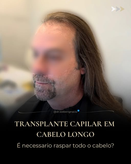 Em alguns pacientes, o transplante capilar pode ser realizado preservando o comprimento dos cabelos.