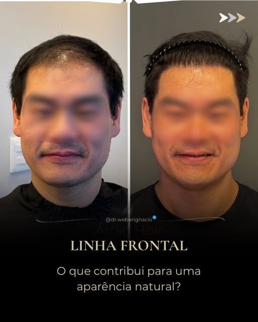 O que faz uma linha frontal parecer natural?

No transplante capilar, a naturalidade não depende de 