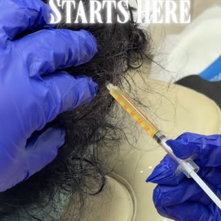Hair restoration, powered by growth factors 🎯
 
#GFCTreatment#SkinWorldClinic #DrAnishaNajeeb #Sili