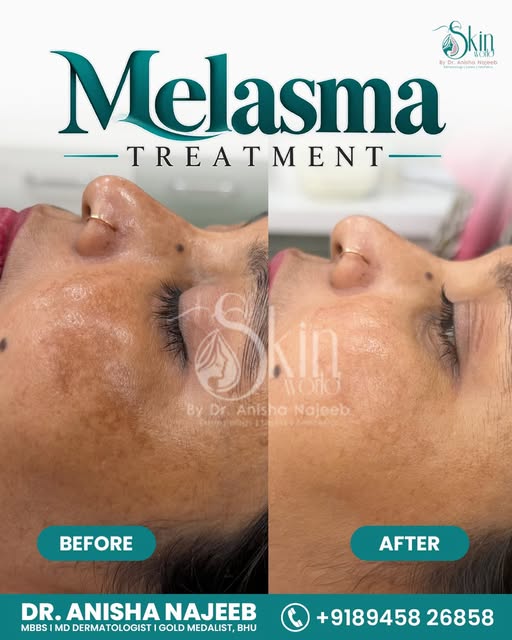 ✨ Real patient progress with personalised Melasma treatment — at Skin World Clinic by Dr. Anisha Naj