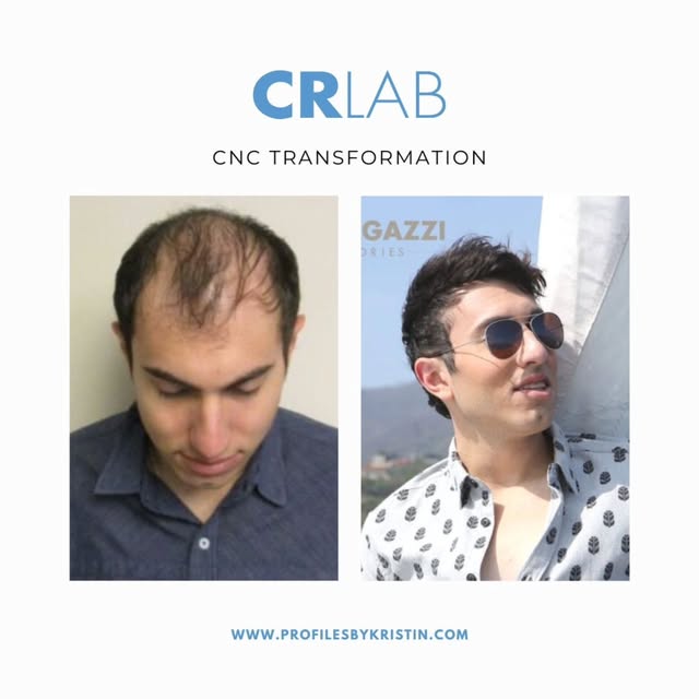 A fuller, natural looking head of hair can make a powerful difference in how you look and how you fe