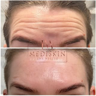 ✨ Botox na czoło – efekty, które zachwycają! ✨

Czy wiesz, że dzięki Botoxowi możesz szybko i skutec