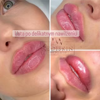 Powiększanie, nawilżanie ust to zabieg dla każdej pacjentki. 

💋 Zalety powiększenia i nawilżenia u